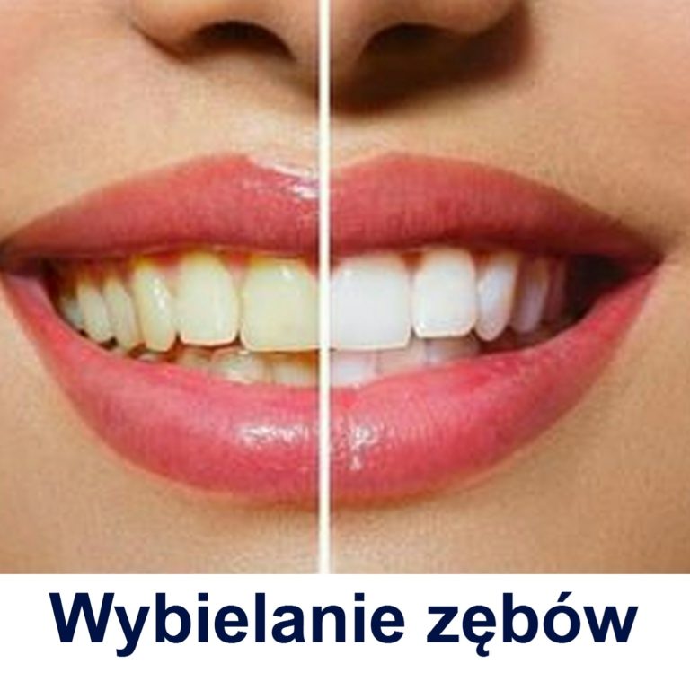 Wybielanie zębów Gdańsk